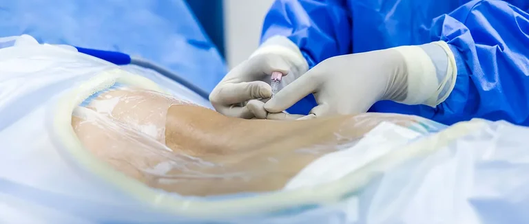 Защемление нерва,