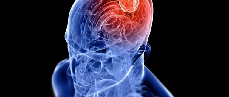 Опухоль мозга