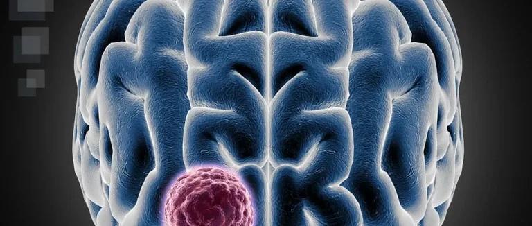 Опухоли мозга