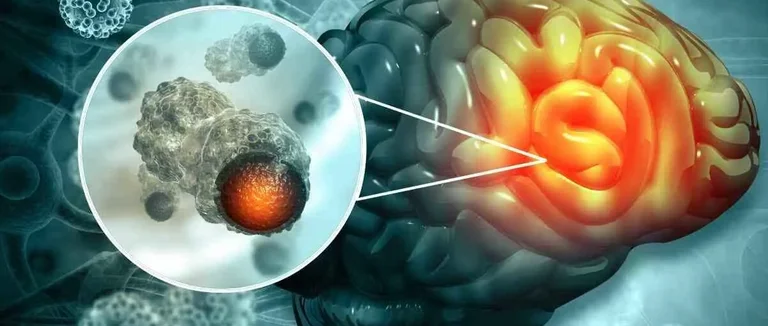 Опухоль головного мозга,