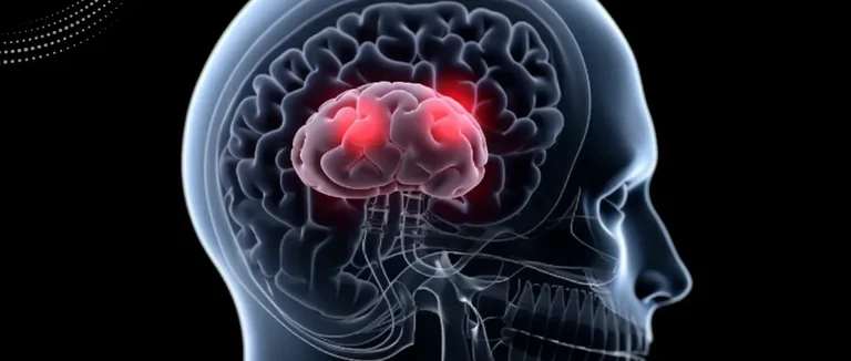 Опухоли головного мозга