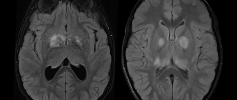 Новообразования головного мозга
