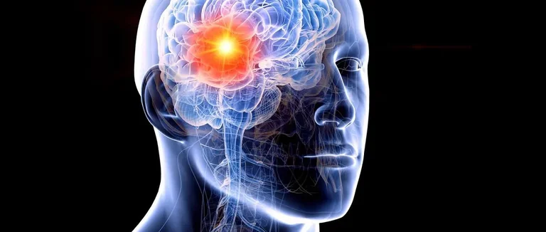 Что такое наиболее распространенные опухоли головного мозга и являются ли они доброкачественными?