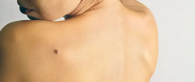 Менингиомы: доброкачественные или злокачественные? Что вам нужно знать о выпученных глазах при опухоли мозга