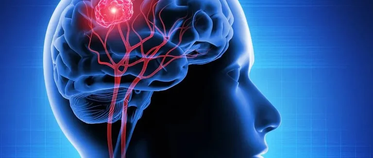 7 Симптомов Опухоли Головного Мозга, Влияющих на Зрение: Ранние Признаки и Предупреждения
