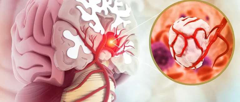 7 Изменений Зрения, Вызванных Опухолями Мозга: Симптомы, Которые Нужно Знать