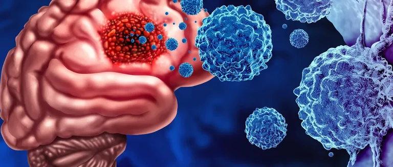 Может ли опухоль мозга вызвать потерю памяти? Объяснение симптомов и осложнений