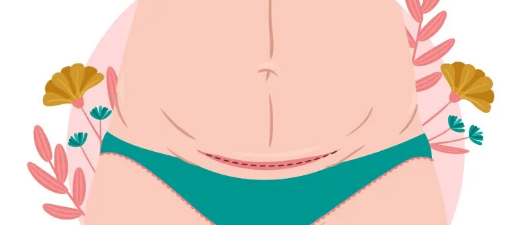 Sectio Ameliyatı Nedir?