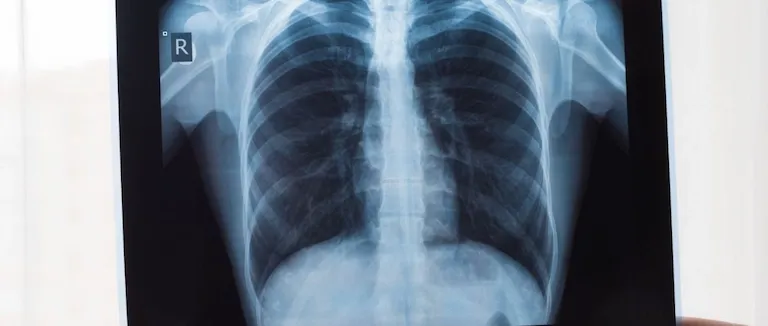 Silikozis Nedir? Belirtileri, Risk Grupları