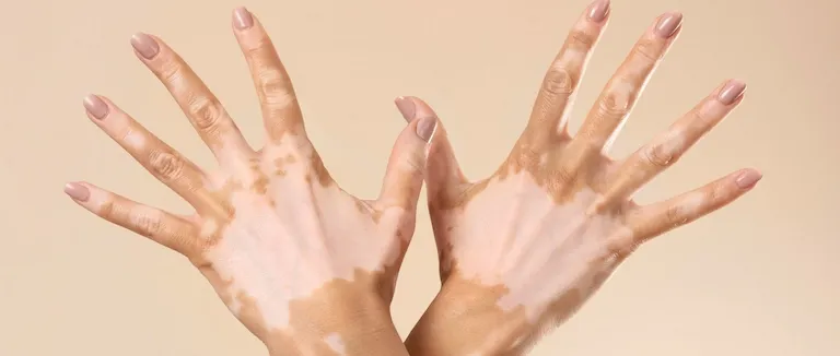Vitiligo tedavisi