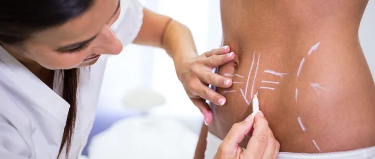 Что такое абдоминопластика (пластика живота)? 3