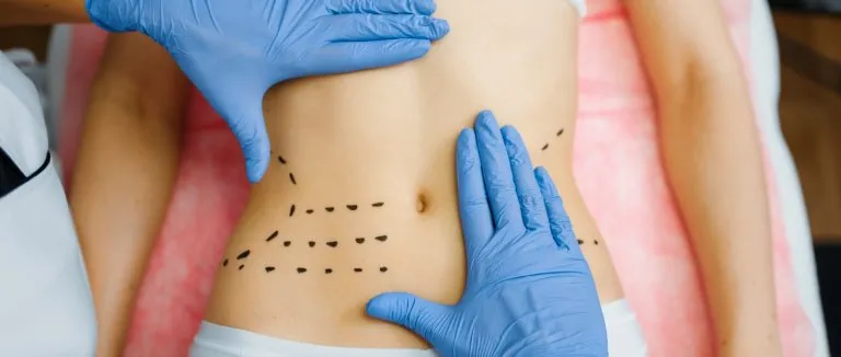 Что такое абдоминопластика (пластика живота)?