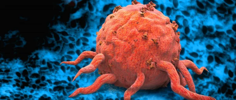 Acute Myeloid Leukemia Prognosis