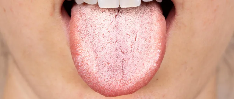 agiz-kurulugu-neden-olur