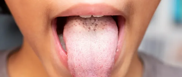 Çocuklarda Ağız Yarasına Ne İyi Gelir?