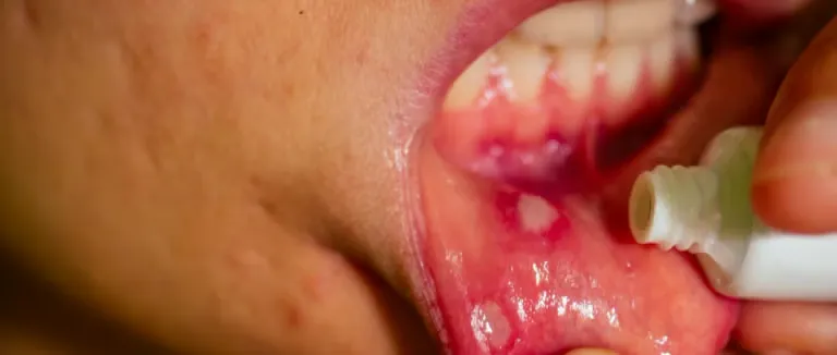Ağız İçi Yara Nedir?