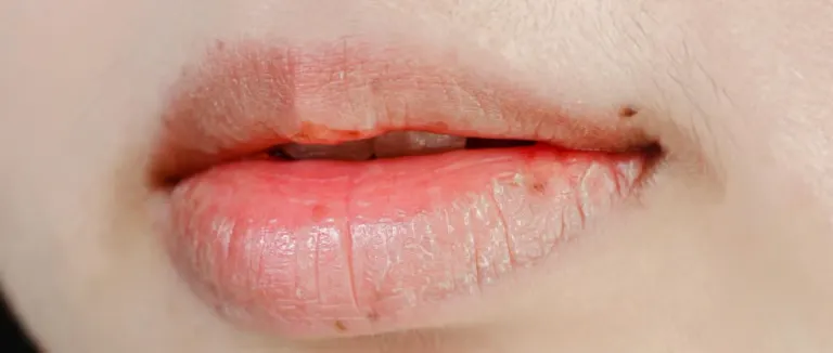 Ağız Yarasına Ne İyi Gelir?