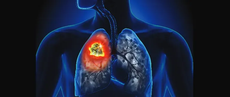 Akciğer Kanserinin Bir Numaralı Nedeni; Sigara