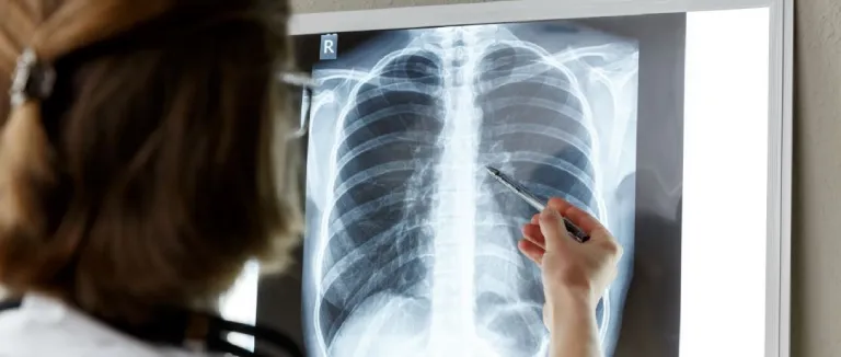 akciğer kanseri Tedavisi