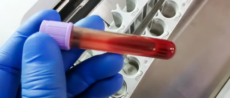 akdeniz-anemisi-tedavisi