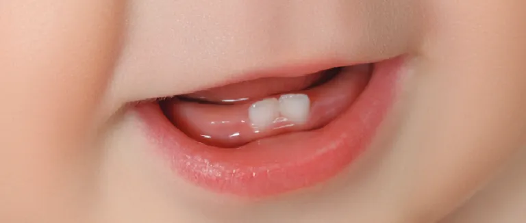 Bebeklerde Diş Çıkarma Serüveni