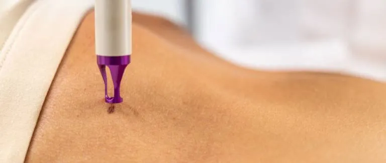 Lazerle Ben Aldırma Operasyonu