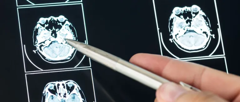Beyin Kanaması Belirtileri ve Tedavisi Nelerdir?