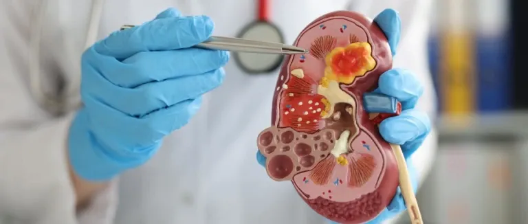 Böbrek Tümörü Belirtileri Nelerdir?