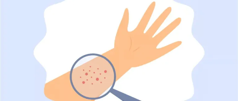 Cüzzam Hastalığı Belirtileri