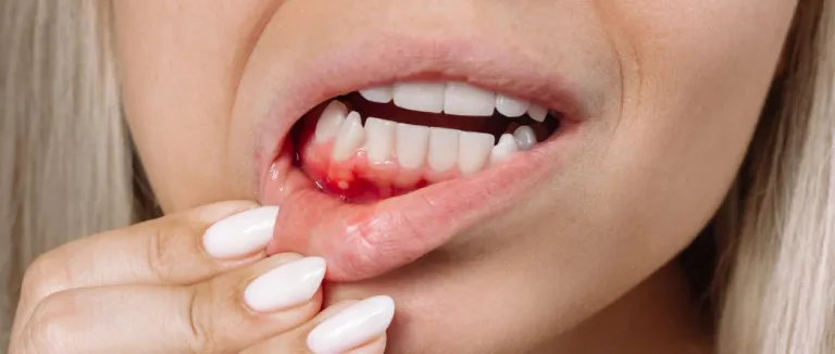 diş eti kanaması nedir