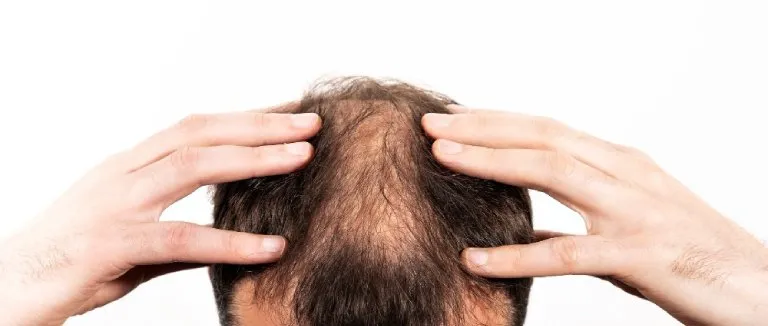 Saç Dökülmesi Nedenleri?