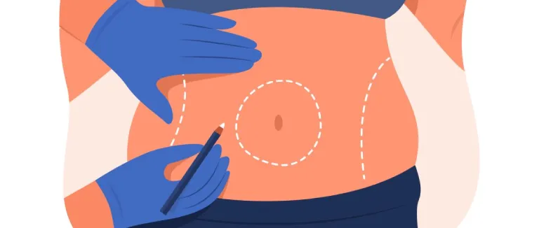 What Does a Gastric Sleeve Do