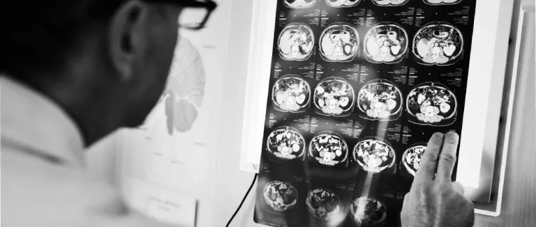 glial-tumor-neden-olur