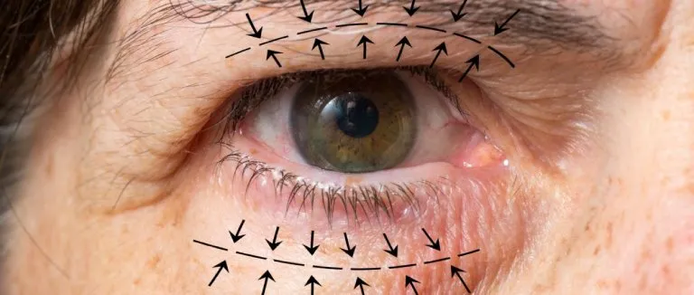 goz-kapagi-ameliyati