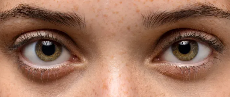 Göz Altı Morlukları Nasıl Geçer?