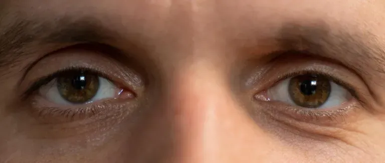 Göz Altı Morluğu Hangi Vitaminlerin Eksikliğinden Kaynaklanır?