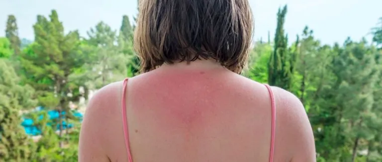 gunes-alerjisi-belirtileri