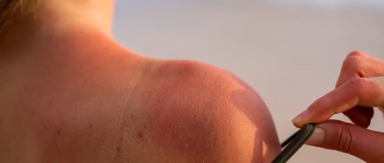 gunes-alerjisi-tedavisi