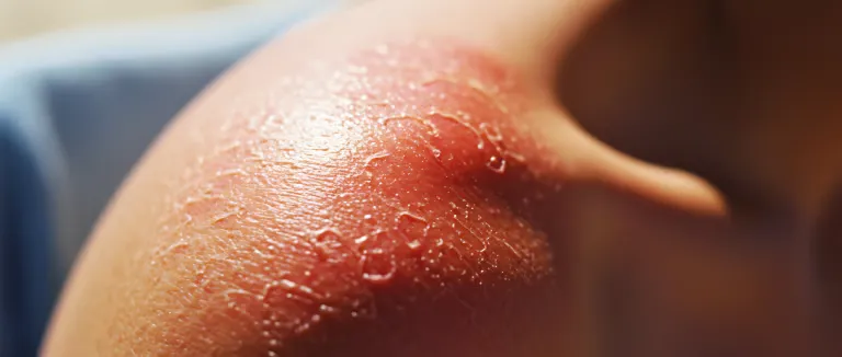 Güneş Yanığı korunma