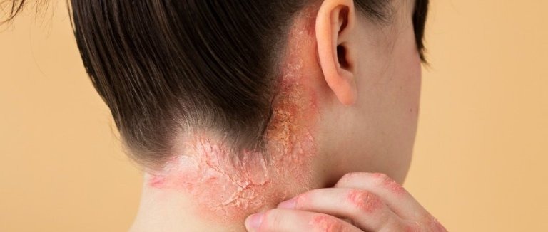 Gül Hastalığı Roza