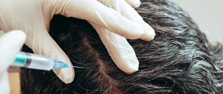 What Is Hair Transplantation