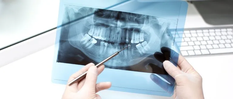 Implants Dentaires en Turquie 2