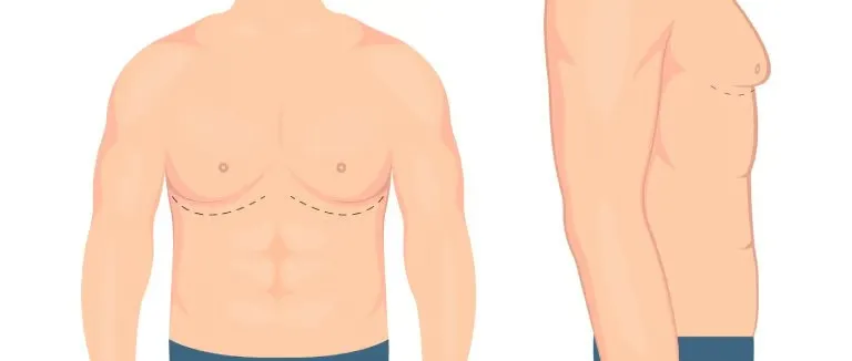 jinekomasti-ameliyati-nedir.