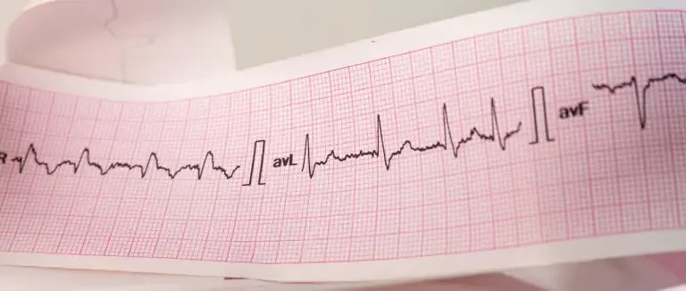 Ventriküler Taşikardi (VT) Ablasyonu Nedir?