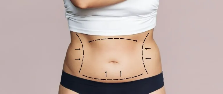 Karın Germe Ameliyatı