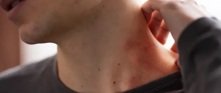 Kaşıntıya Ne İyi Gelir?