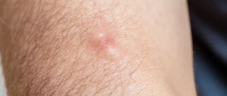 Keloid Nedir?