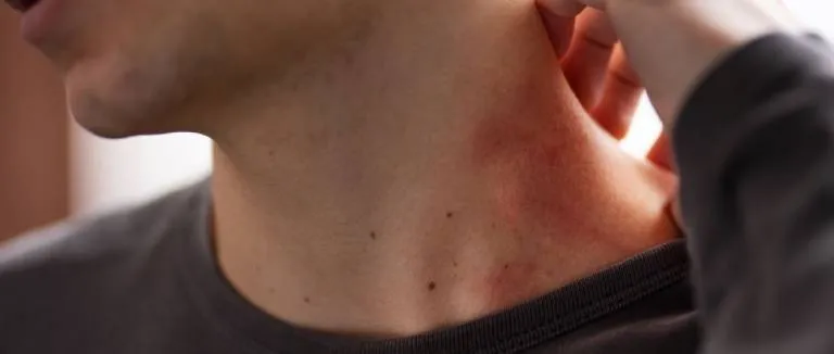 Kıl Kökü İltihabı