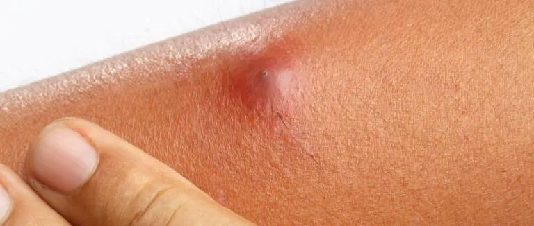 Kıl Kökü İltihabı Neden Olur?