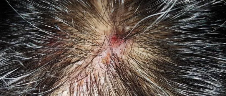 Kıl Kökü İltihabı Belirtileri